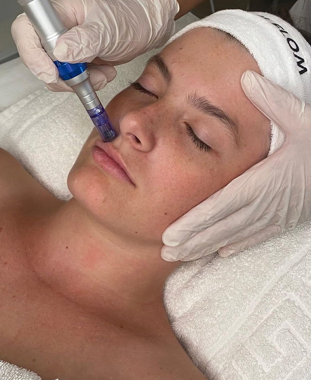 Cosmetología — tratamiento con dermapen