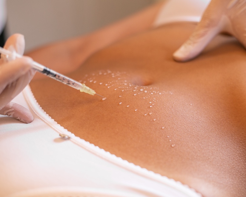 Mesoterapia corporal - Belleza corporal